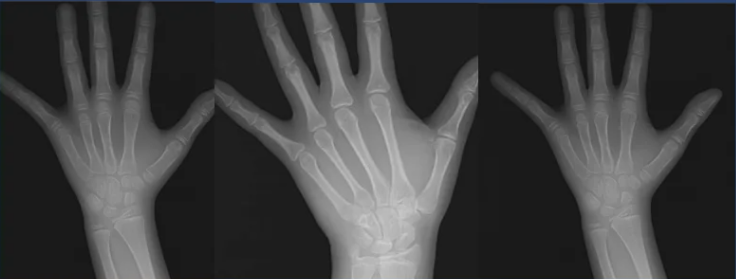 Radiografia carpal — mão e punho